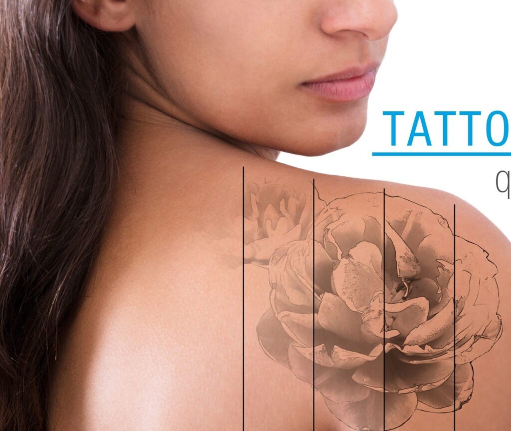 Tattoo removal